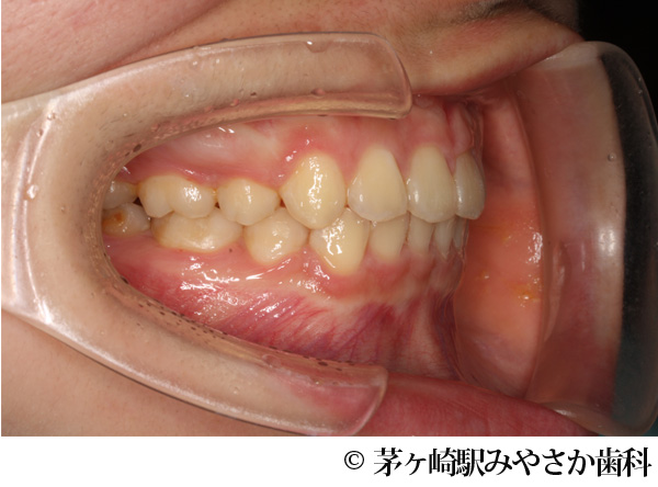治療後