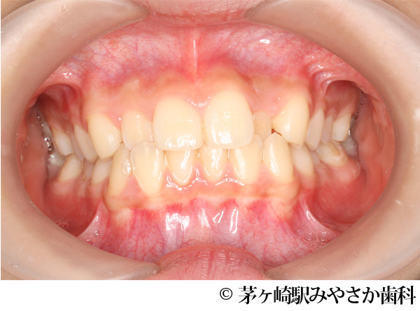 治療前
