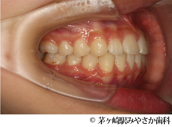 治療後