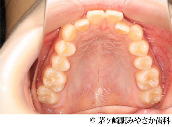 治療前
