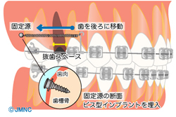 インプラント矯正