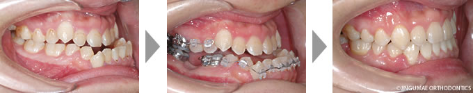 受け口(下顎前突)、歯のでこぼこの症例
