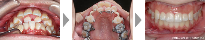 歯のでこぼこ、出っ歯(上顎前突)の症例