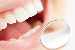 矯正治療の終了