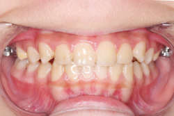 ���꼰��󥬥륢��������