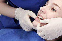 矯正装置の除去