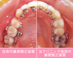 リンガルブラケット