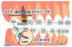 ミニインプラントを利用した矯正治療