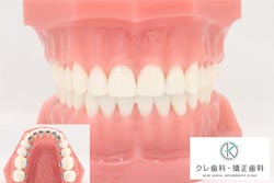 裏側矯正