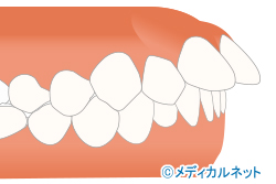 出っ歯(上顎前突)