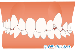 叢生(八重歯、乱杭歯)