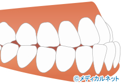 受け口(下顎前突)