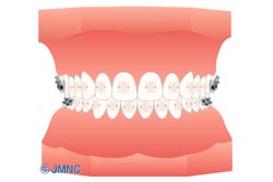 【表側矯正(審美性に配慮したブラケット)】