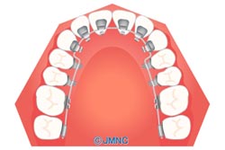 【裏側矯正(上下顎)】