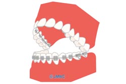 【裏側矯正(上顎のみ)】