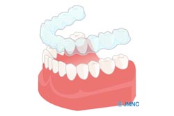 【マウスピース矯正】