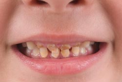 お子様の矯正治療