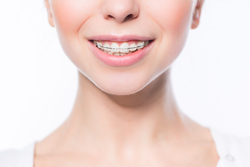 目立ちにくい表側矯正