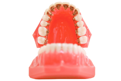 目立ちにくい・見えにくい裏側矯正