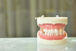 公的医療保険適用の矯正治療(顎変形症)