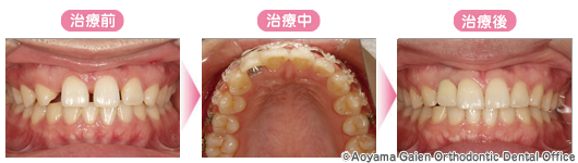 矯正治療体験 症例特集 矯正歯科ネット 矯正歯科の専門サイト