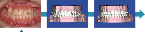 叢生-ガタガタの歯並びの画像