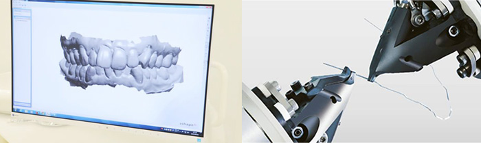 3Dデジタル矯正システムによる矯正治療 - 矯正歯科ネット 矯正歯科の