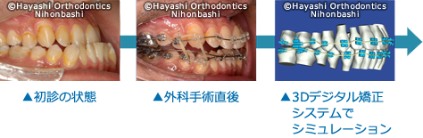 下顎前突-受け口、下顎が上顎より前に出ている状態の画像