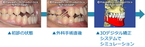 下顎前突＋開咬-受け口で前歯がかみ合わず開いている状態の画像