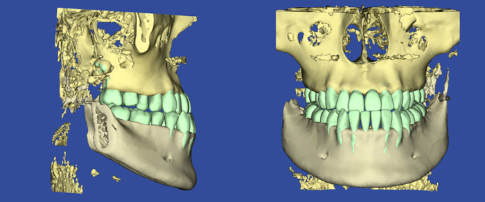 初診時の患者様の顎の3Dモデル画像