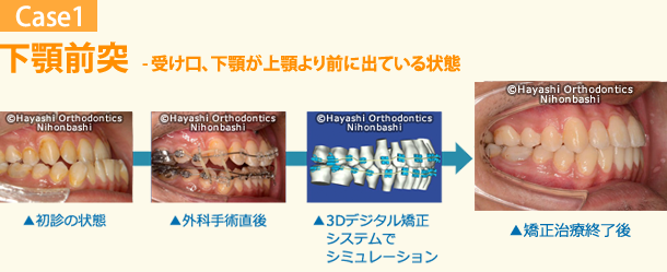 デジタル矯正システムを併用した新しい外科的矯正治療 - 矯正
