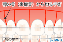 コルチコトミー手術