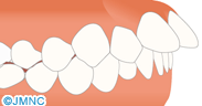 上顎前突(出っ歯)