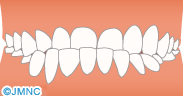 下顎前突(受け口)