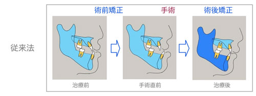 従来の外科的矯正