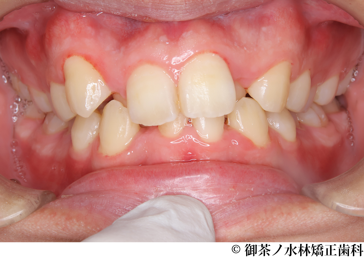 治療前
