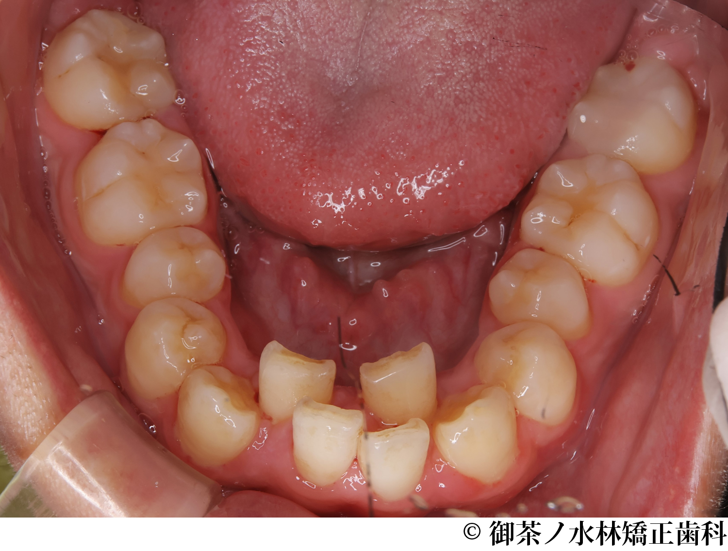 治療前
