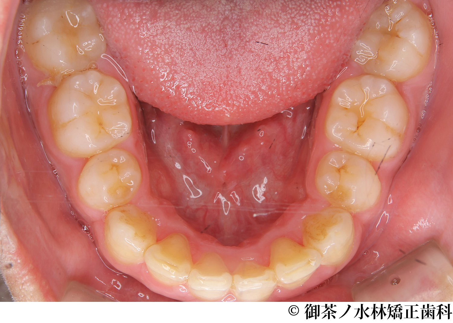 治療後