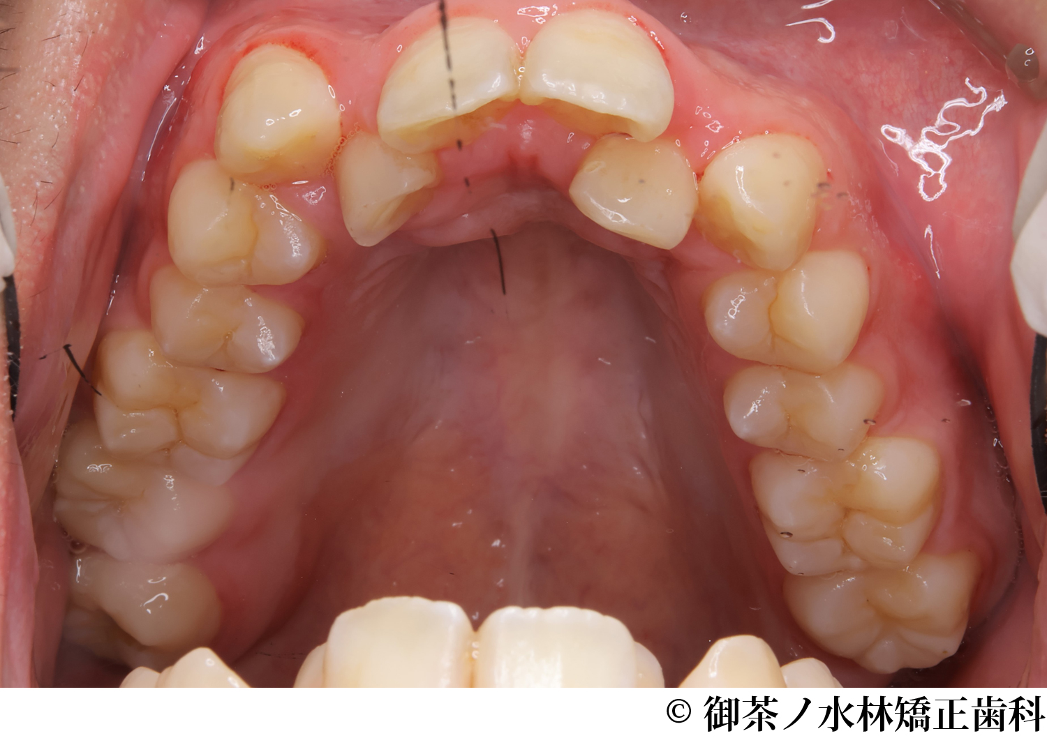 治療前