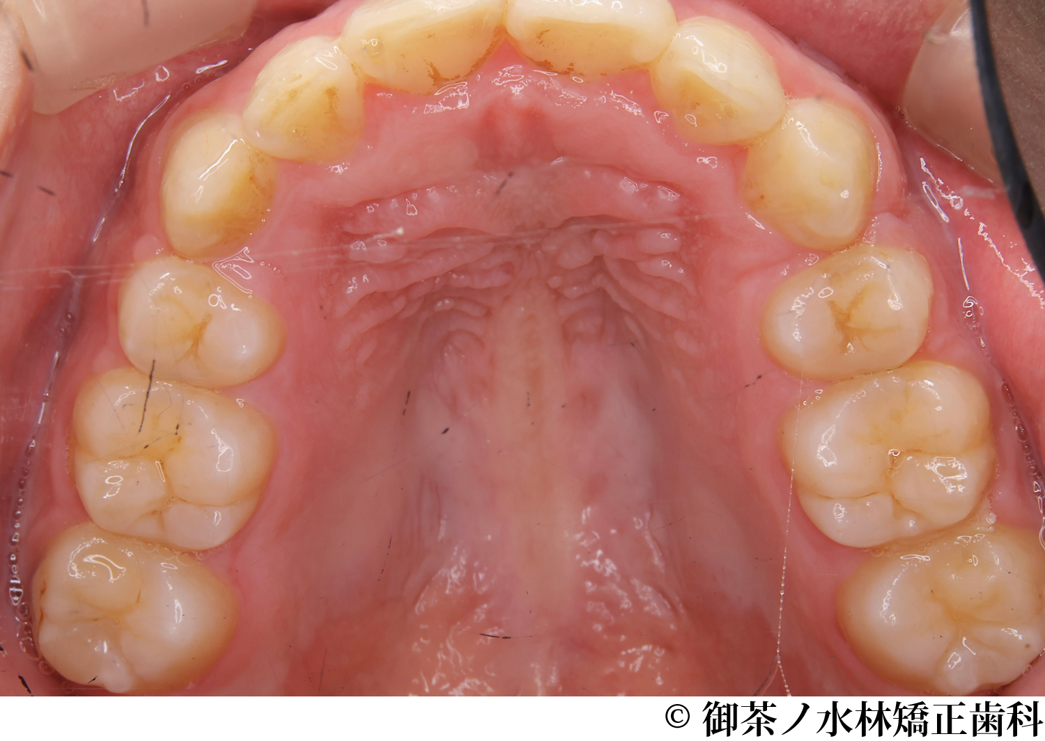 治療後