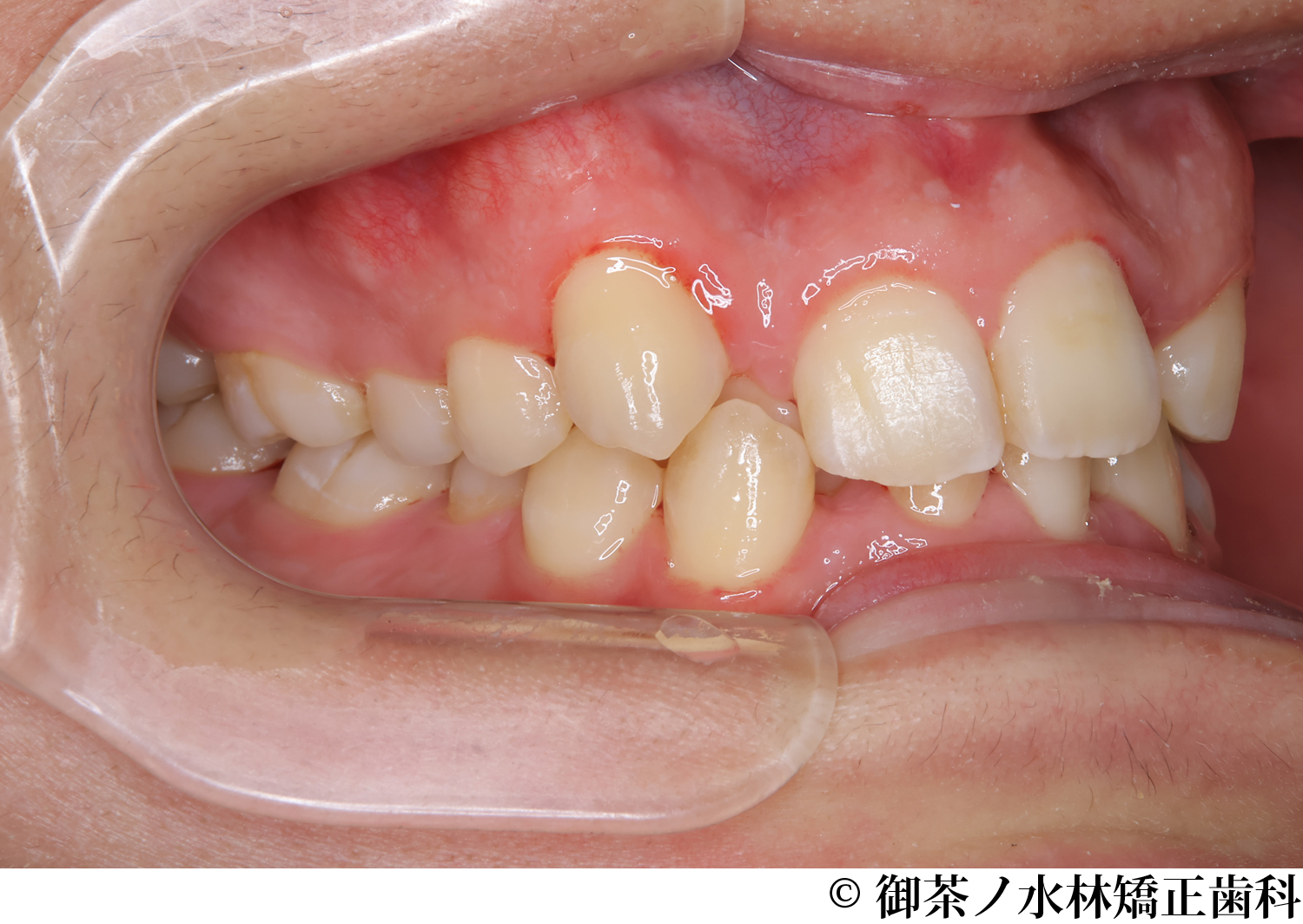 治療前