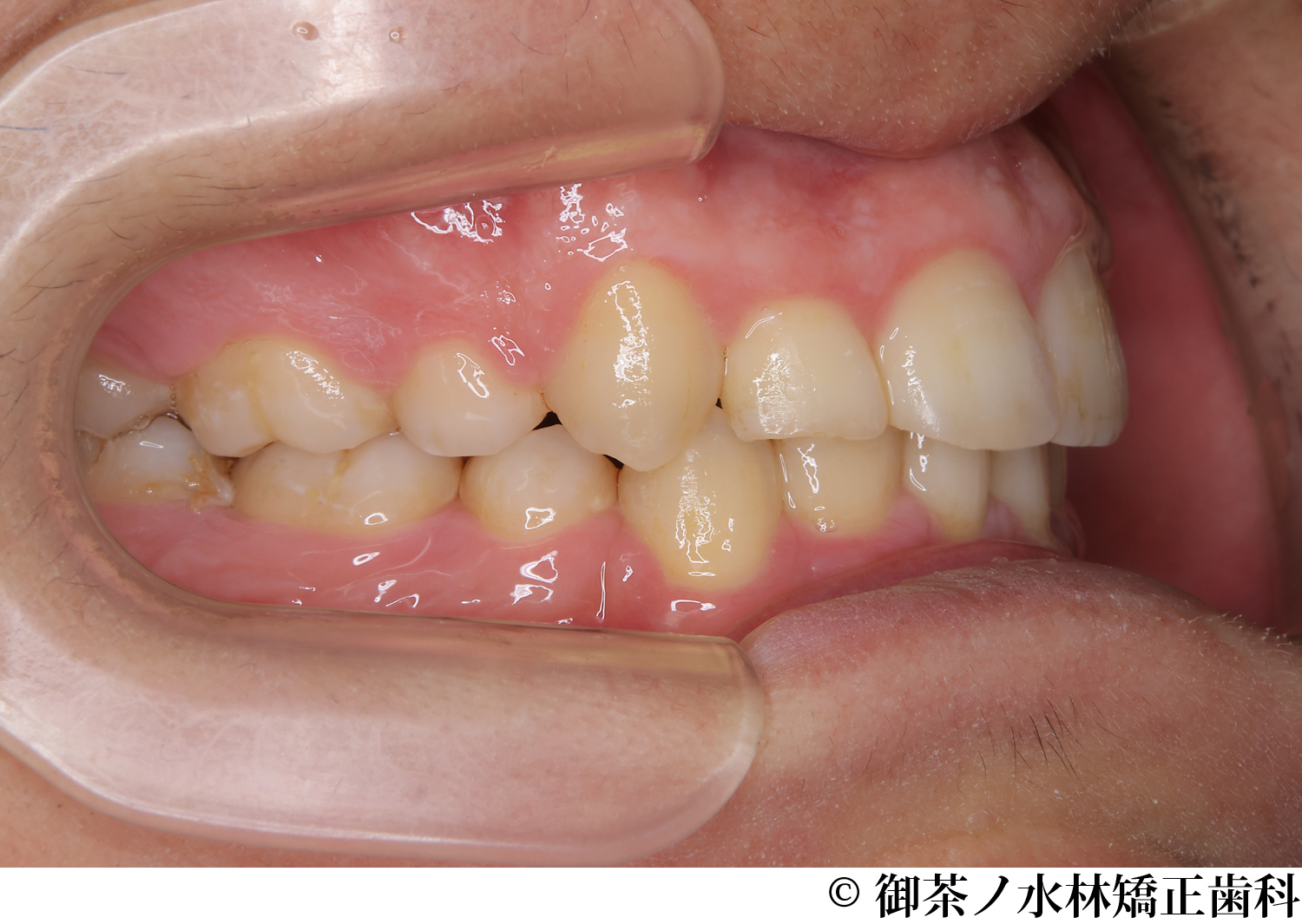 治療後