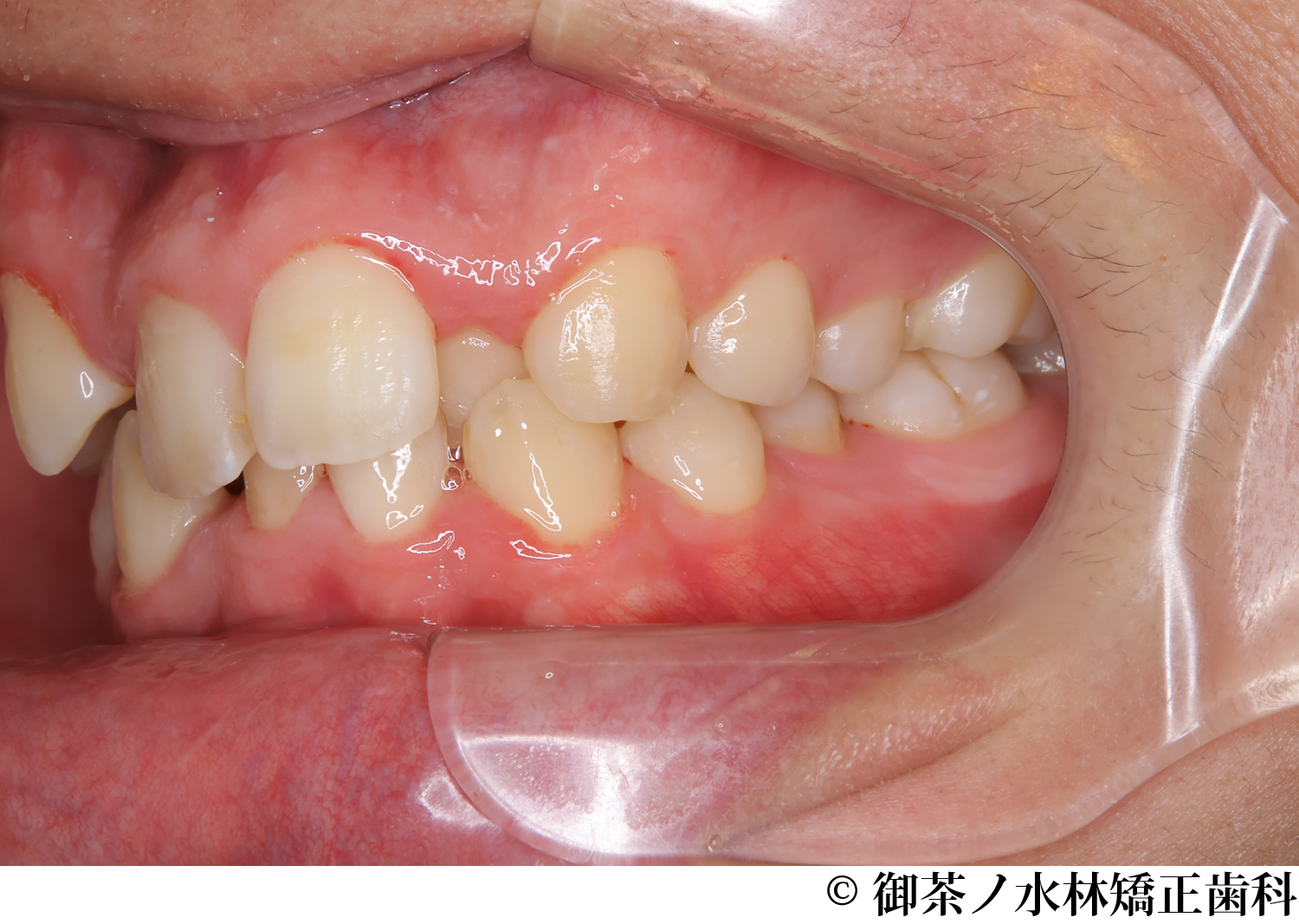 治療前