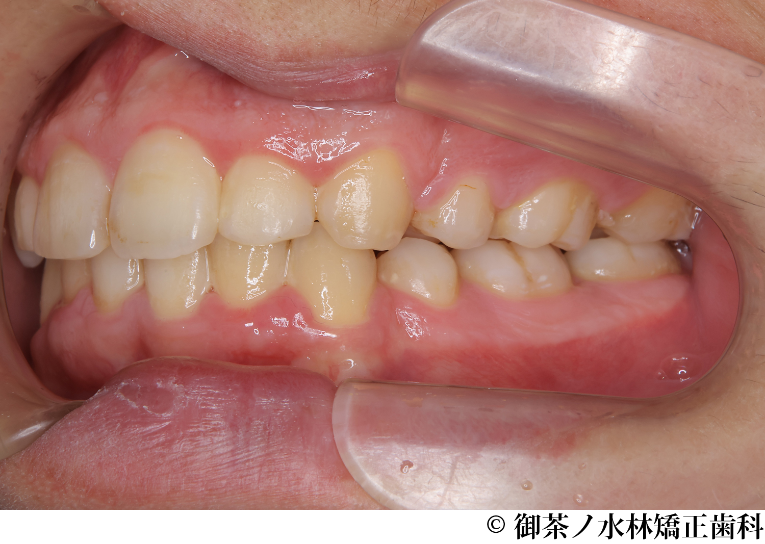 治療後
