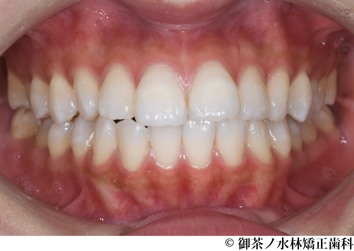 治療前