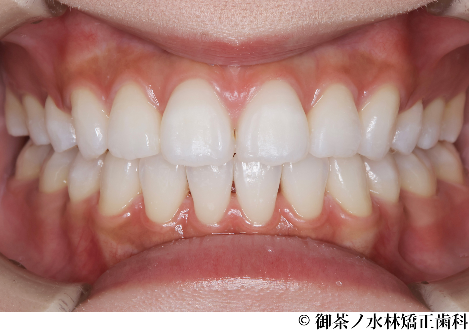 治療後