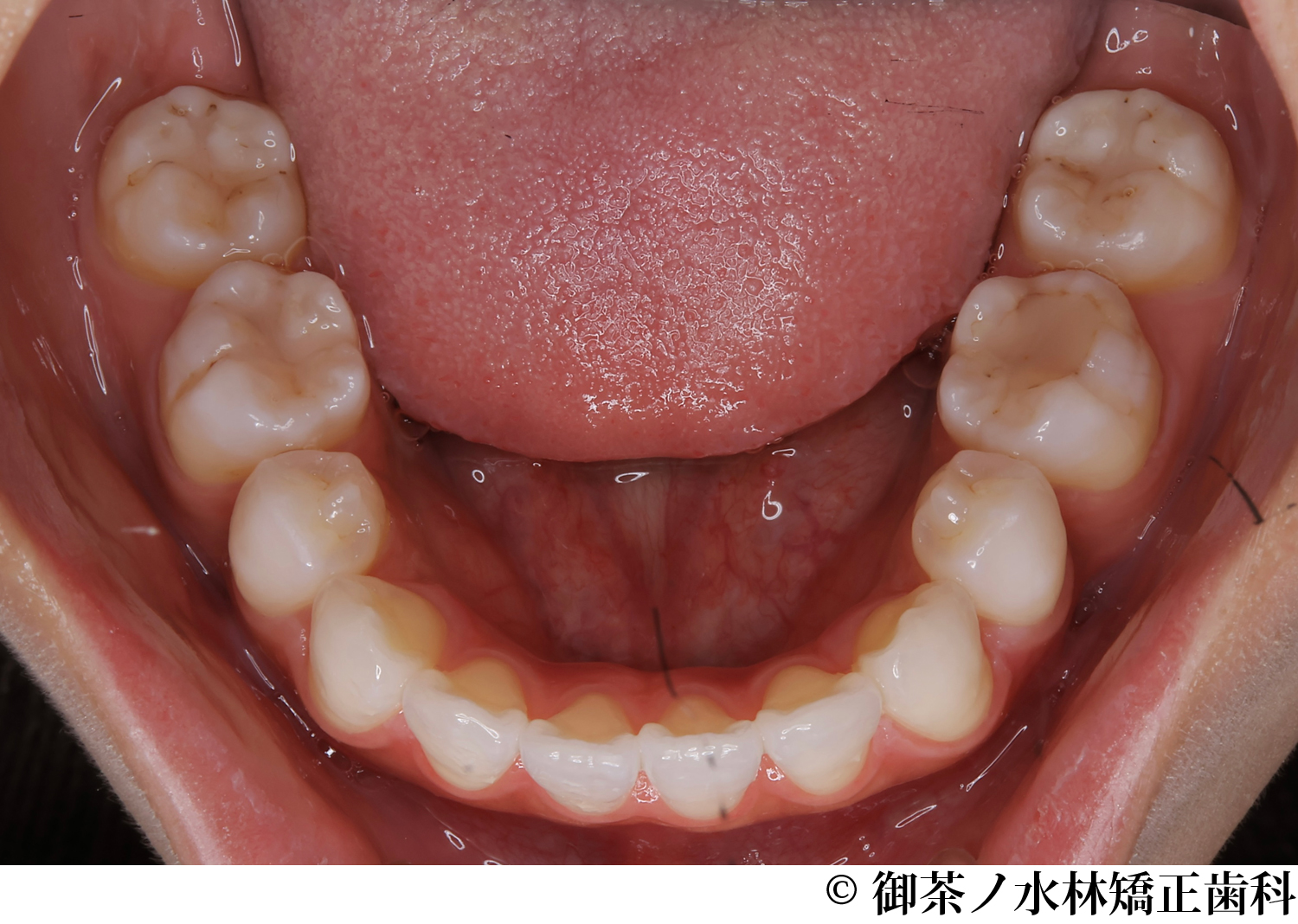 治療後