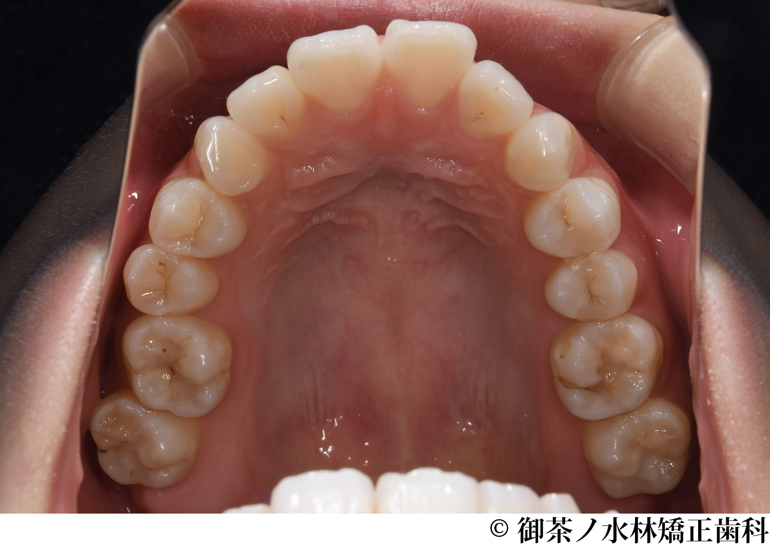 治療前