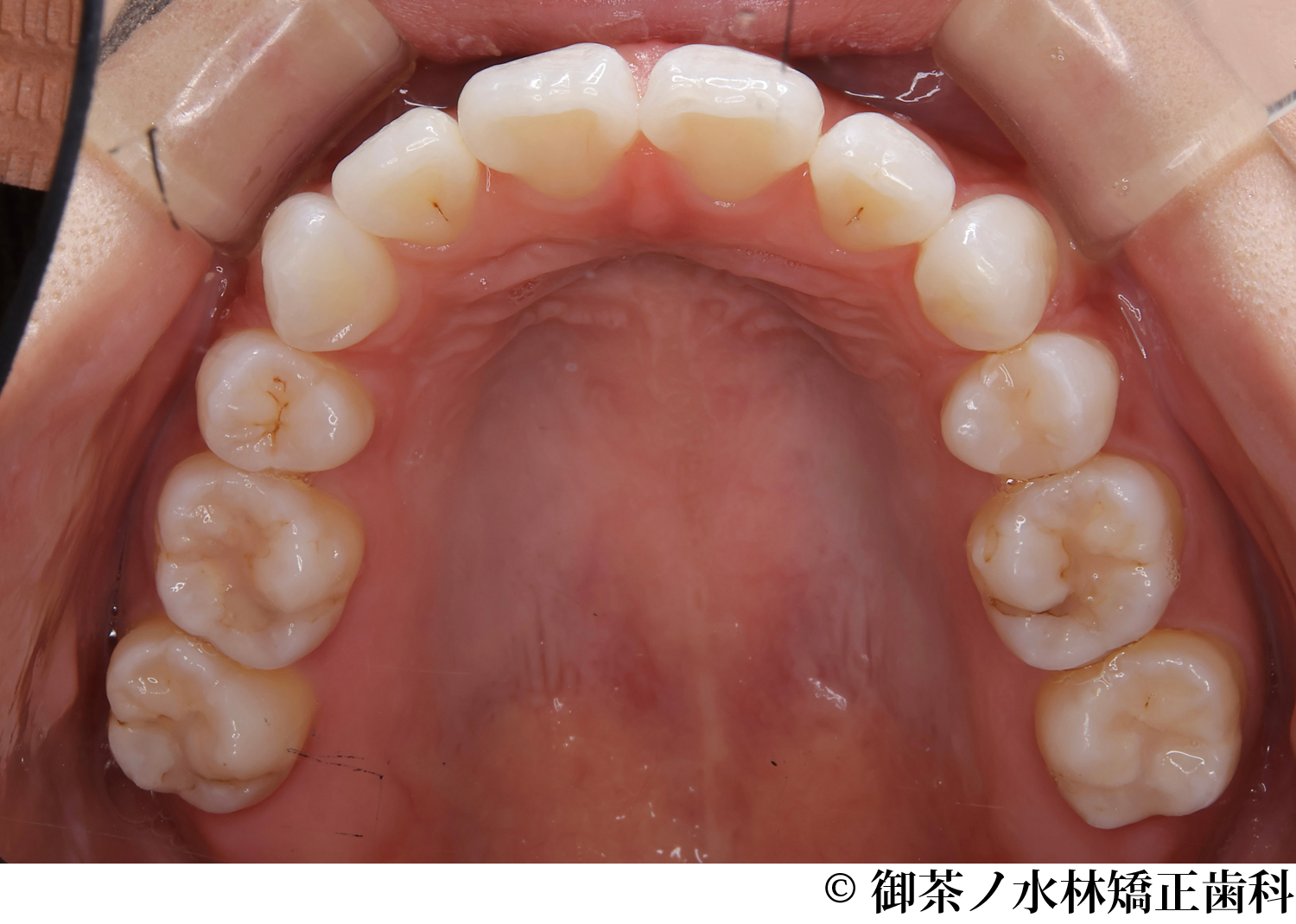 治療後