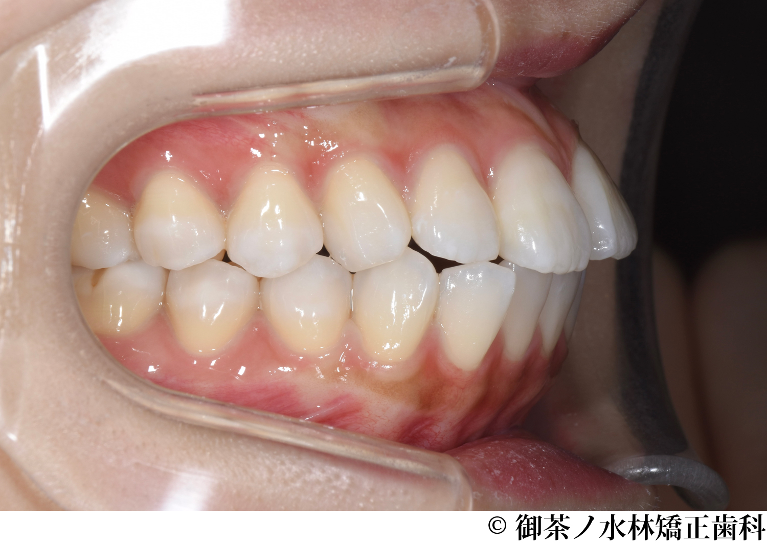 治療前